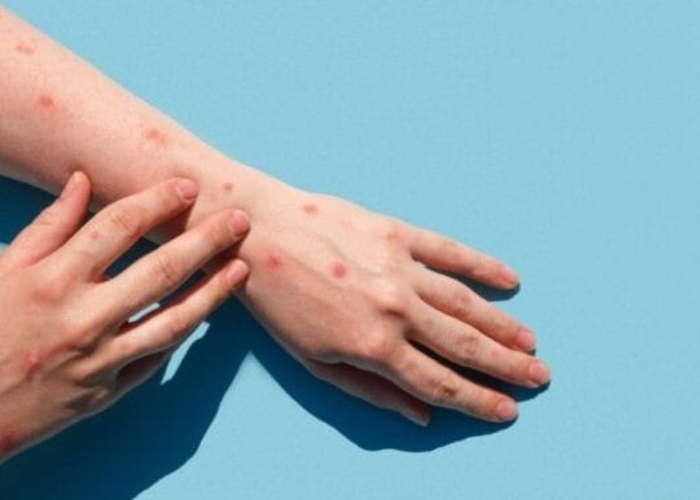 Dinkes DKI Jakarta Siapkan Tenaga Medis di Puskesmas untuk Tangani Kasus Cacar Monyet