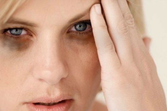 Lingkar Hitam di Bawah Mata? Ini Cara Menghilangkannya Tanpa Perawatan Mahal