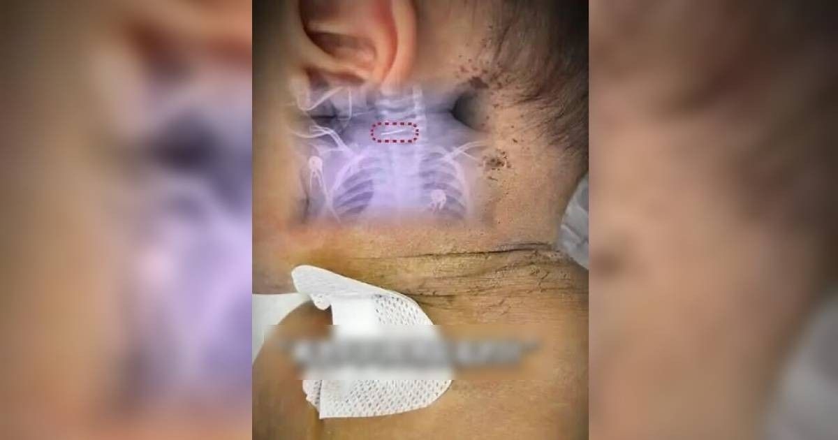 Bayi Dilarikan ke Rumah Sakit, Ditemukan 600 Bekas Tusukan Jarum di Lehernya