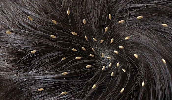 Kondisioner Cukup Ampuh Basmi Telur Kutu