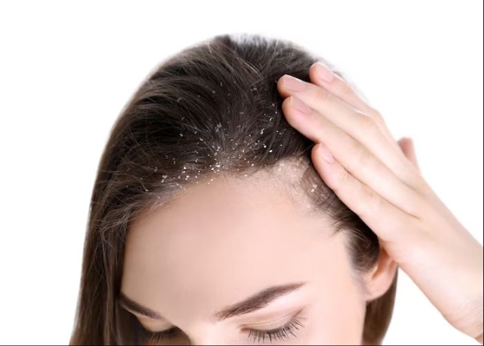 Cara Menghilangkan Ketombe dengan Mudah dan Praktis, Kenali Penyebab dan Tips Mencegahnya Agar Tidak Kambuh!