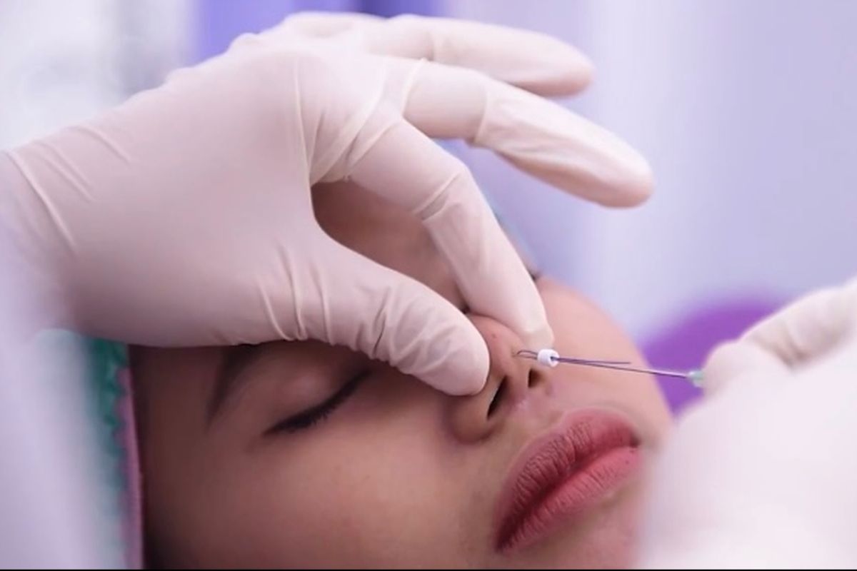 Jangan Keliru, Ketahui Perbedaan Botox Dan Filler Wajah