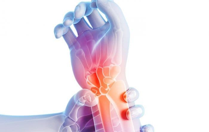 Kenali Apa Itu Carpal Tunnel Syndrome, Lengkap Pengobatannya
