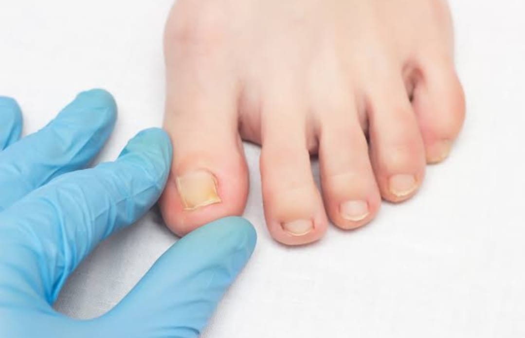 7 Penyebab Kuku Kaki Berwarna Kuning, Salah Satunya Adalah Infeksi Jamur