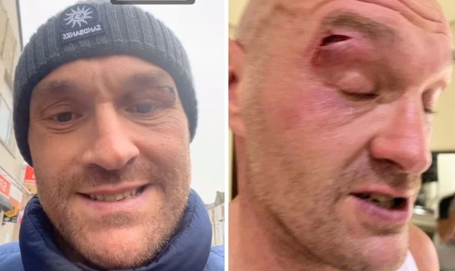 Promotor Oleksandr Usyk Ragukan Video dan Foto Luka yang Bikin Tyson Fury Tunda Pertarungan