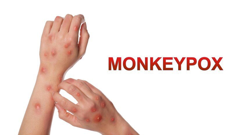 Filipina Umumkan Dua Kasus Mpox Varian Lebih Ringan