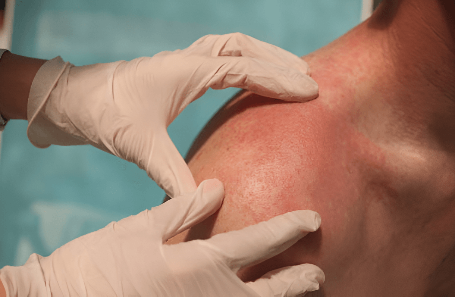 Kulit Terinfeksi Bakteri? Ini Langkah Mudah Mengatasinya