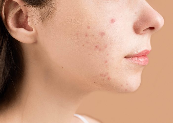 Cara Menghilangkan Bekas Jerawat secara Alami, Aman, dan Minim Efek Samping