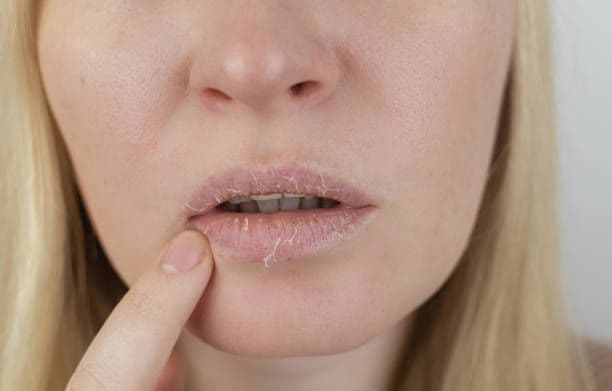 Cara Mengatasi Bibir Kering dan Pecah-pecah, Wajib Dicoba